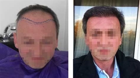 turkey hermes|hermest hair transplant reviews.